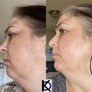 Cosmelan Peel Treatment